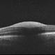 Preretinal Hemorrhage - OCT Preretinal Hemorrhage - OCT